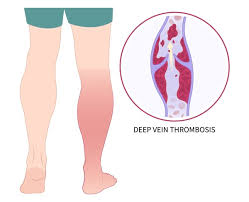 DVT